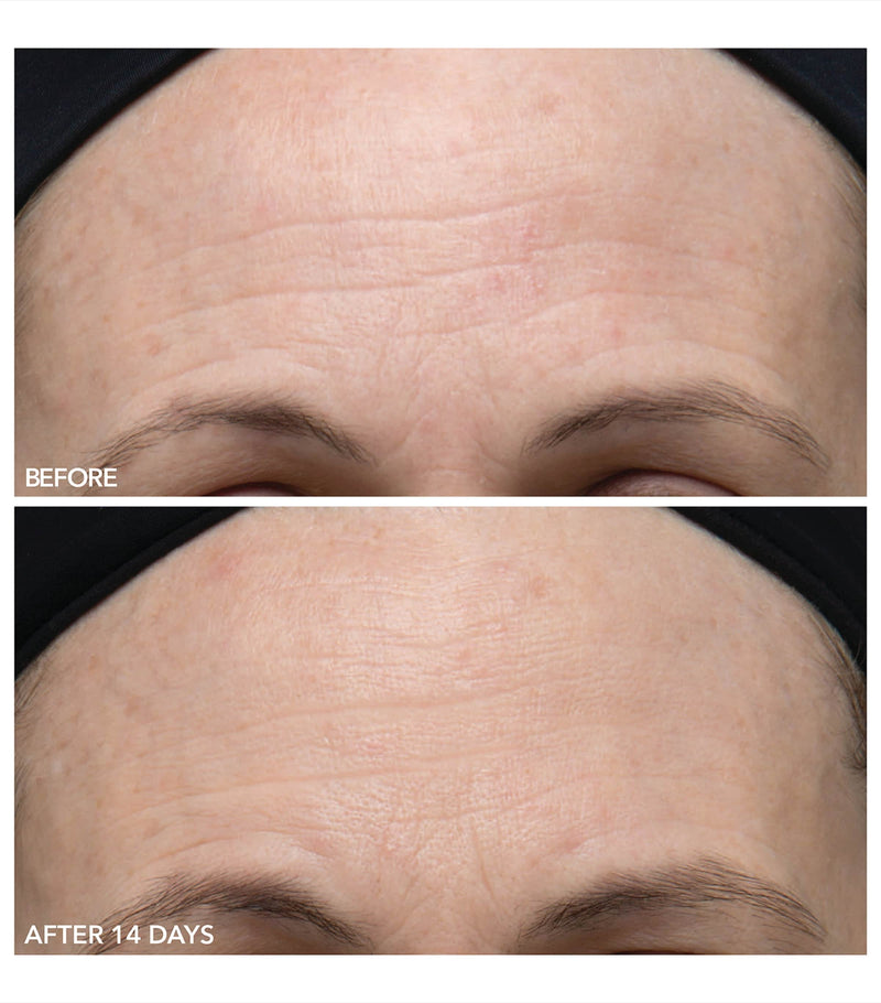 Dr Dennis Gross Alpha Beta Gentle Peel (5 Treatments)