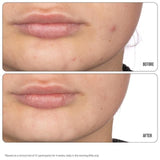 Nip+Fab Retinol Fix Blemish Treatment Gel 10% 15ml