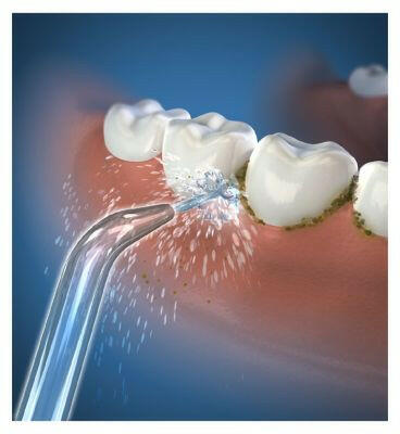 Waterpik Replacement Classic Jet Tip JT-100E Dental Boots