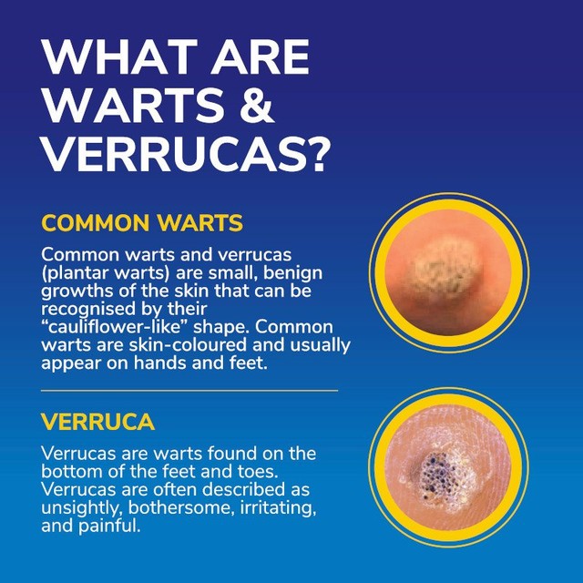 Dr Scholl's FreezeAway Max wart and verruca removal device - British product