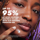 Acnecide spot treatment gel with benzoyl peroxide 15g - British product