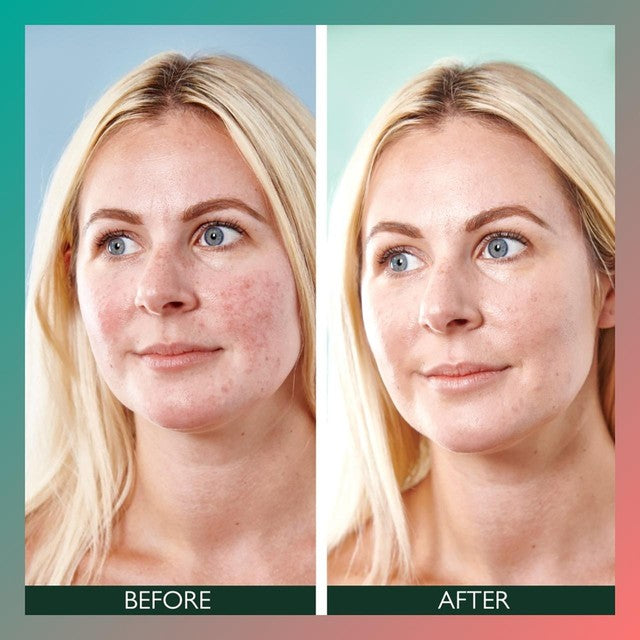Sorted Skin 5 in 1 Anti-Redness SPF50 Day Cream - Prebiotic Microbiome