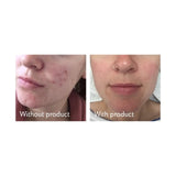Science of Skin Rescue Facial Scarring