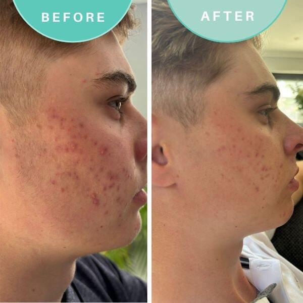 SkinGenius acne treatment gel with Oregon Grape 30ml (British brand)