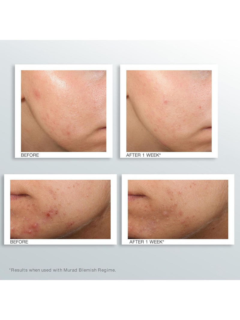 Murad Outsmart Blemish Clarifying Serum 50ml, imported from the UK
