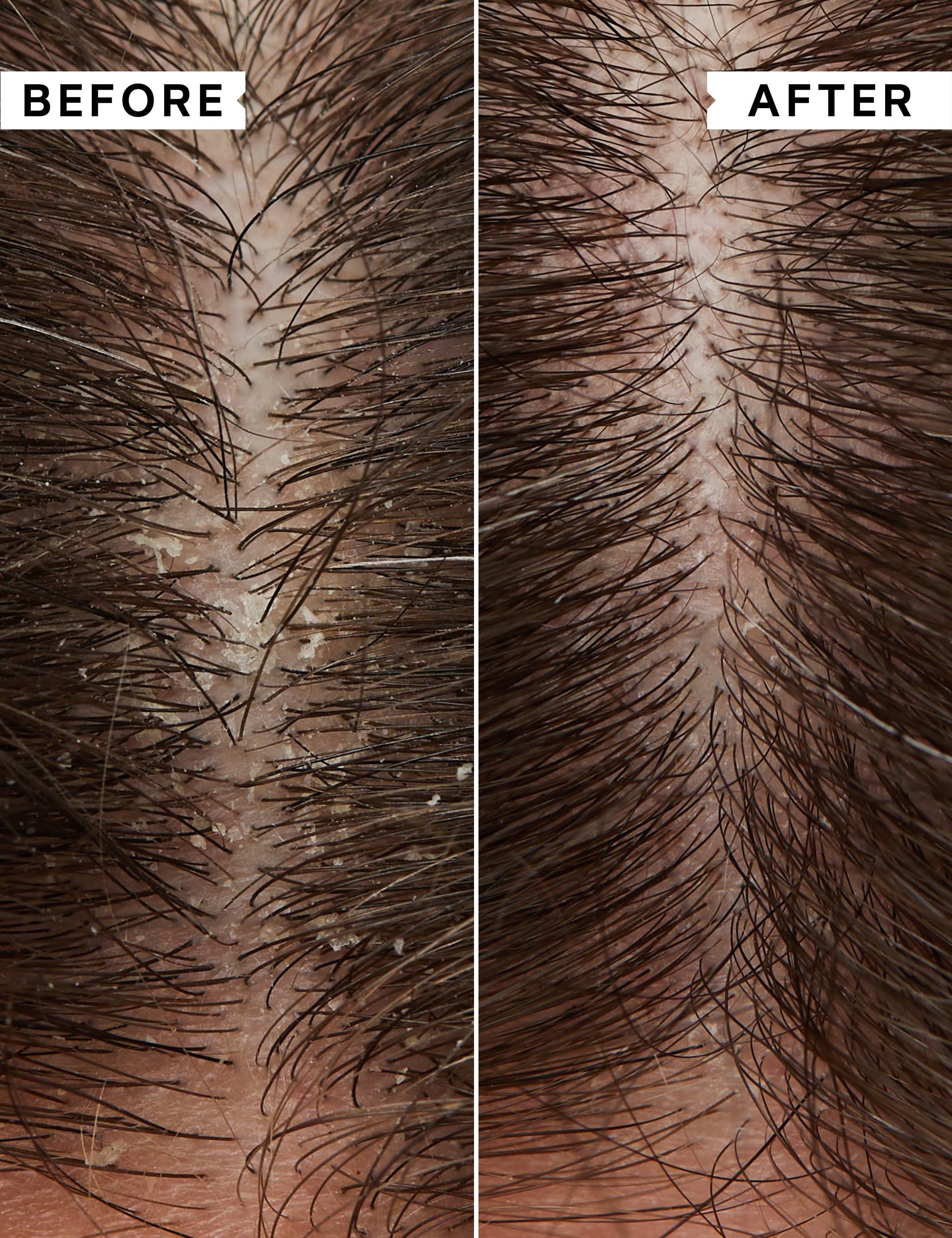 Philip Kingsley flaky itchy scalp treatment kit with mask shampoo and toner - British product