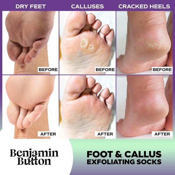 Benjamin Button luxury foot peel socks 5 pairs - British product