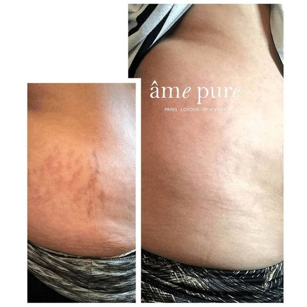 âme pure Body Basic | Stretch Marks 0.75mm - McGrocer
