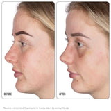 Nip+Fab Retinol Fix Blemish Treatment Gel 10%   15ml