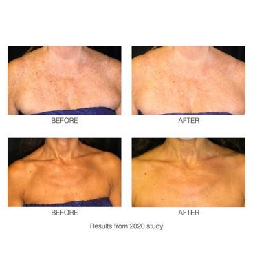 Rio DecoLITE Beauty boost LED light Treatment