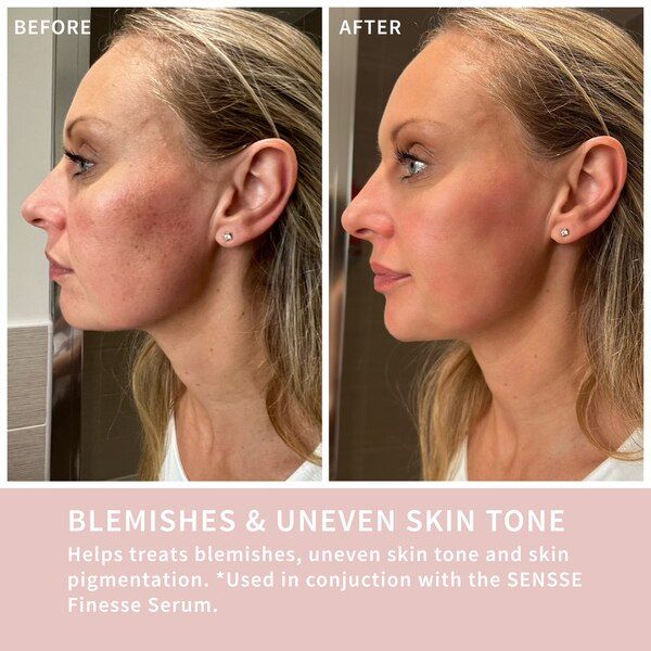 SENSSE LED Light Therapy Mask